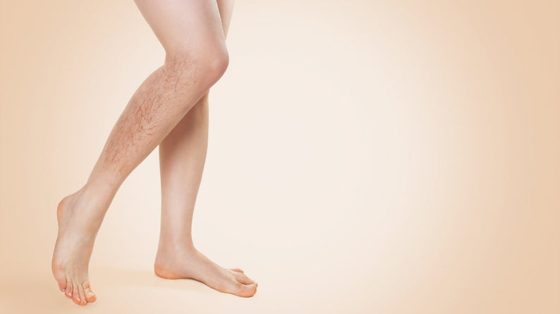 Wassereinlagerungen: Ursache,Symptome und Tipps - Venen Engel Online Magazin