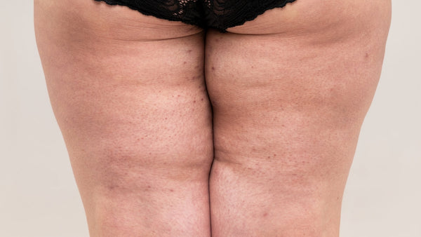 Lymphödem: Ursachen, Symptome und Alltagstipps für ein besseres Verständnis und Wohlbefinden - Venen Engel Shop